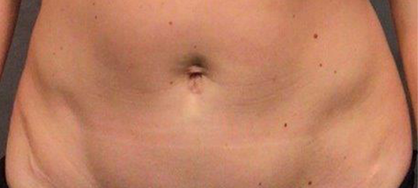 Tummy Tuck Before-1