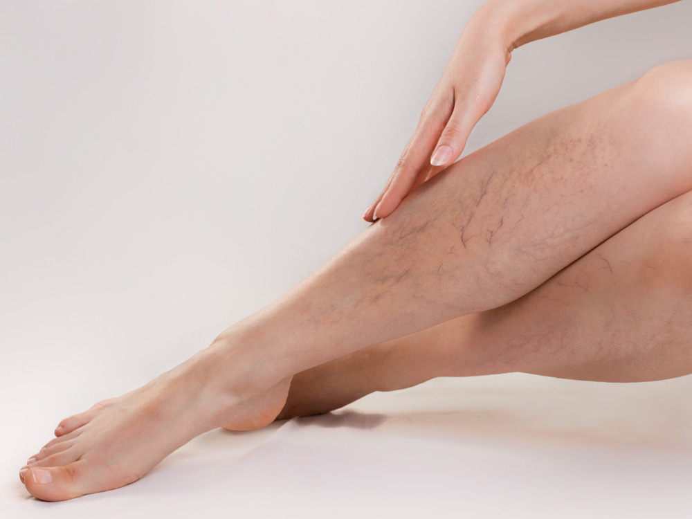 Sclerotherapy Spider Vein Treatment Deaconess Cosmetic Dermatology