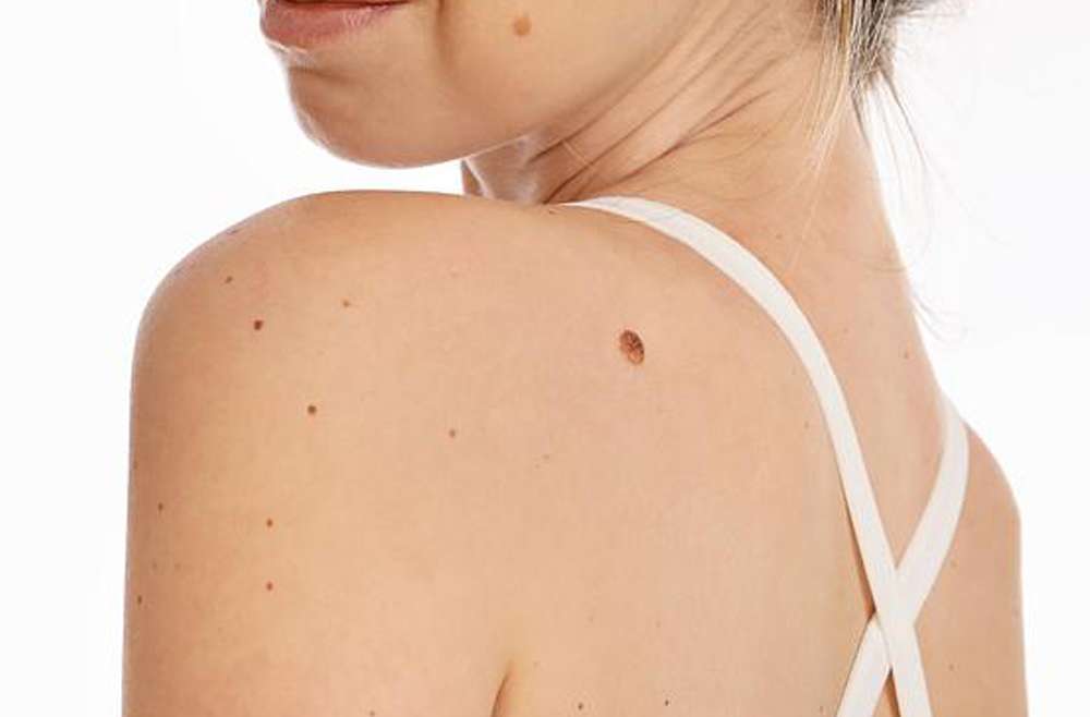 Skin Tag Removal