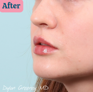 patient 4 after lips