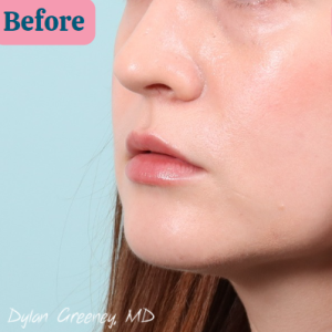 patient 4 Before lips